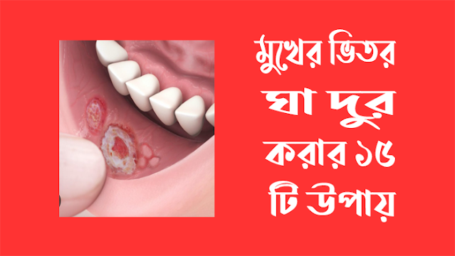 মুখের ভিতর ঘা দূর করা ১৫ টি উপায়
